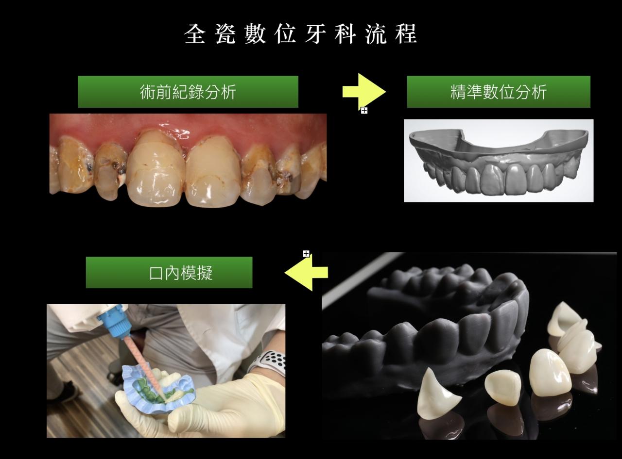 全瓷美學 全瓷美學
