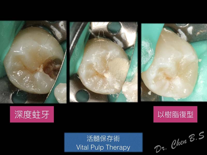活髓保存術 活髓保存術