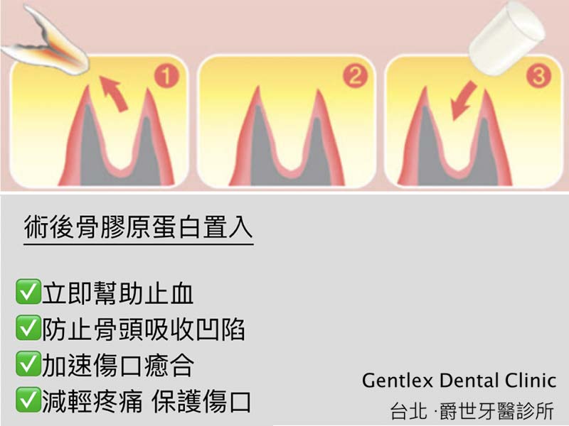 微創智齒手術 微創智齒手術
