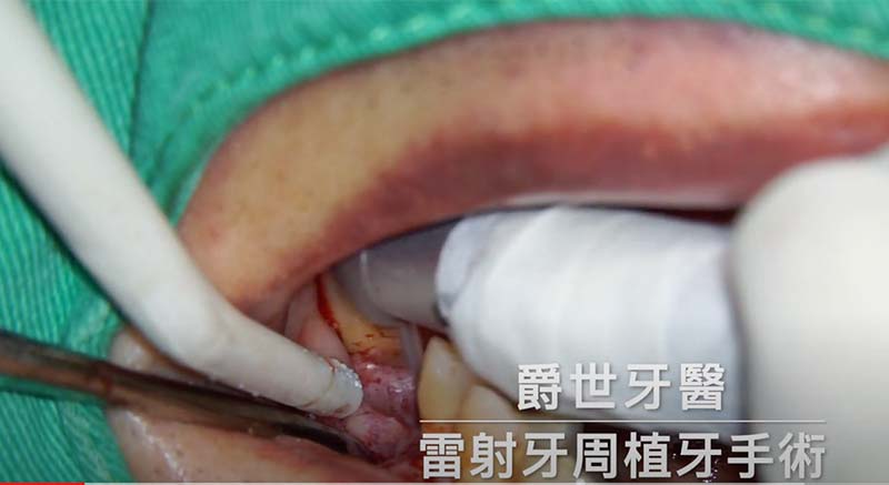 水雷射牙周植牙治療