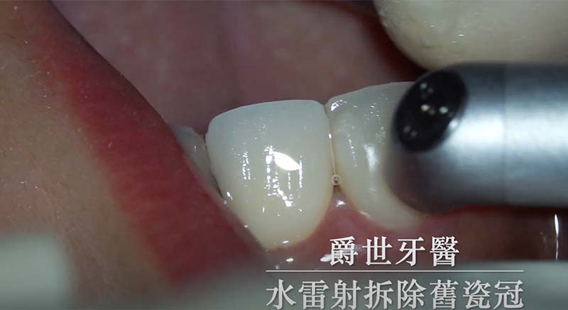 水雷射移除全瓷冠