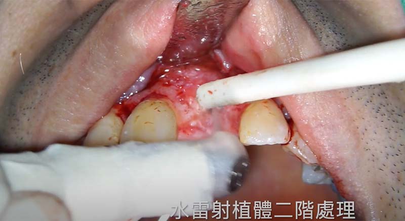 水雷射植牙手術