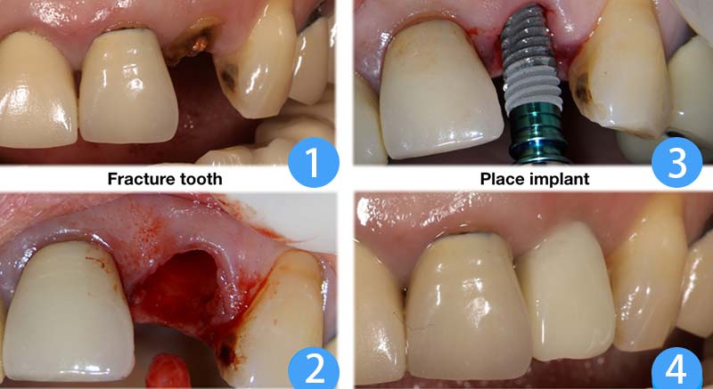 數位植牙即拔即種